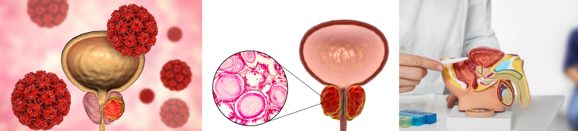 Prostait Prevention, Detection and Management of Prostate Cancer - St Vincents ...